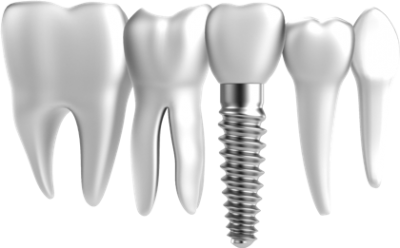 Nail, White, Dental implant, Tooth Transparent Photos Hd Download PNG Images
